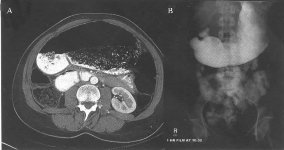 图1 A. 腹部增强CT示充满食物残渣的巨大胃扩张；B. 上消化道泛影葡胺造影示严重胃扩张，但没有明显的梗阻（点击看大图）。