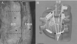 图4 A. 尸体上沿后纵隔与食管交界处的切面；B．左心房与走行于其下面的冠状窦、气管和主支气管、食管以及迷走神经（箭头）的相对位置关系（点击看大图） 