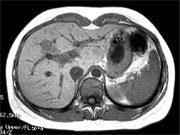  图1 MRI可见肝脏左右叶交界处一实质占位病变，T1加权为低信号——点击看大图